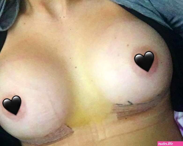 Hollys Breast Enlargement
