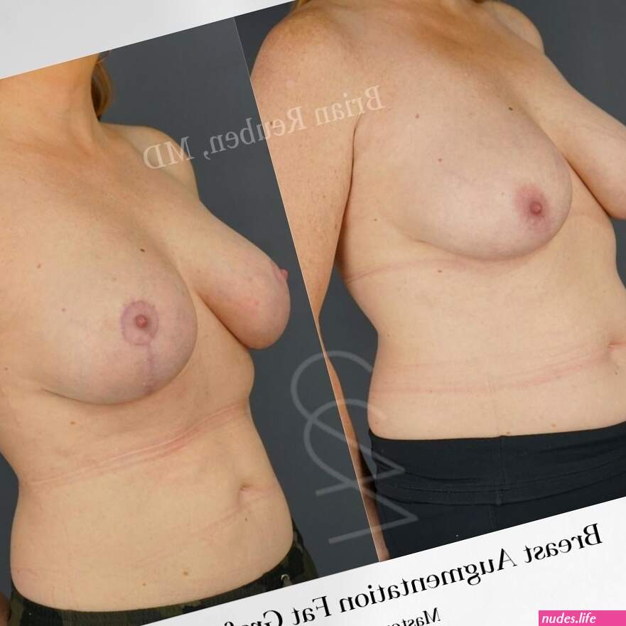 Fat Transfer to Breast