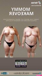 Mommy Makeover Surgery in Tijuana Mexico