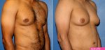 Body Banking Gynecomastia Photos