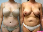 Tummy Tuck Abdominoplasty Before and After Pictures Case 233