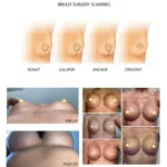 Breast Surgery Scarring Guide
