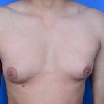 Why Does My Gynecomastia Look Better When Its Cold?