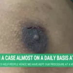 PUFFY NIPPLE SURGERY RESULTS WITH SCARLESS KEYHOLE GYNECOMASTIA TECHNIQUE
