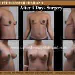 Benefit Breast Fat Transfer ThailandNatural Breast Augmentation Thailand