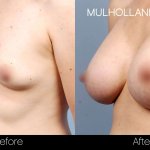 Whats the Difference: Fake Boobs vs. Real Boobs