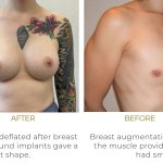 Breast Augmentation London