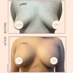 Breast Augmentation