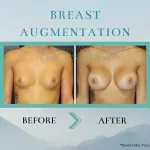 How to Choose New Breast Implants