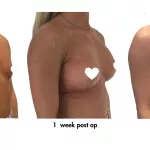 Breast Enlargement and Implants