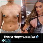 Boob Job in Turkey: Book Breast Augmentation in Turkey