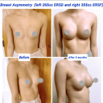 What Causes Breast Asymmetry and How to Fix it