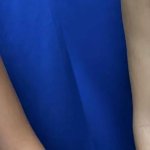 Breast Augmentation Before After Gallery: Patient 298