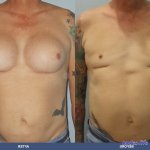 mtof hormone boobs pics