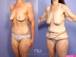 After Weight Loss Before and After Photo Gallery