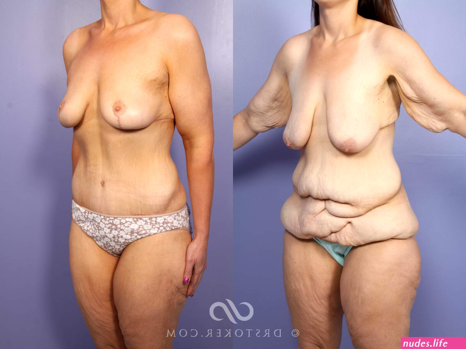 Before after nude