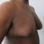 When Does A Puffy Nipple Become Gynecomastia?