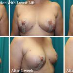 Natural breast augmentation with fat transfer in Wisconsin