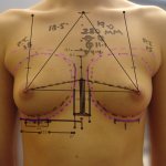 What Size Breast Implants Should I Get For My Boob Job?