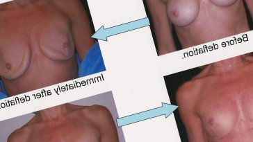 Saline in boobs