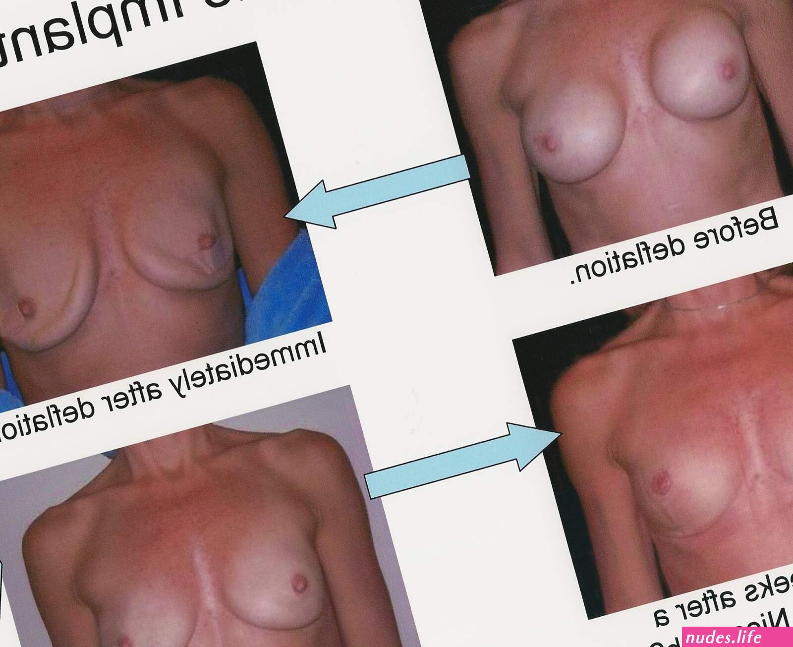 Saline in boobs